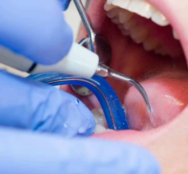 עקירה רגילה לעקירה כירורגית בטיפולי שיניים